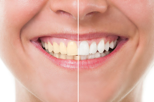 Professional Teeth Whitening Blanco TX