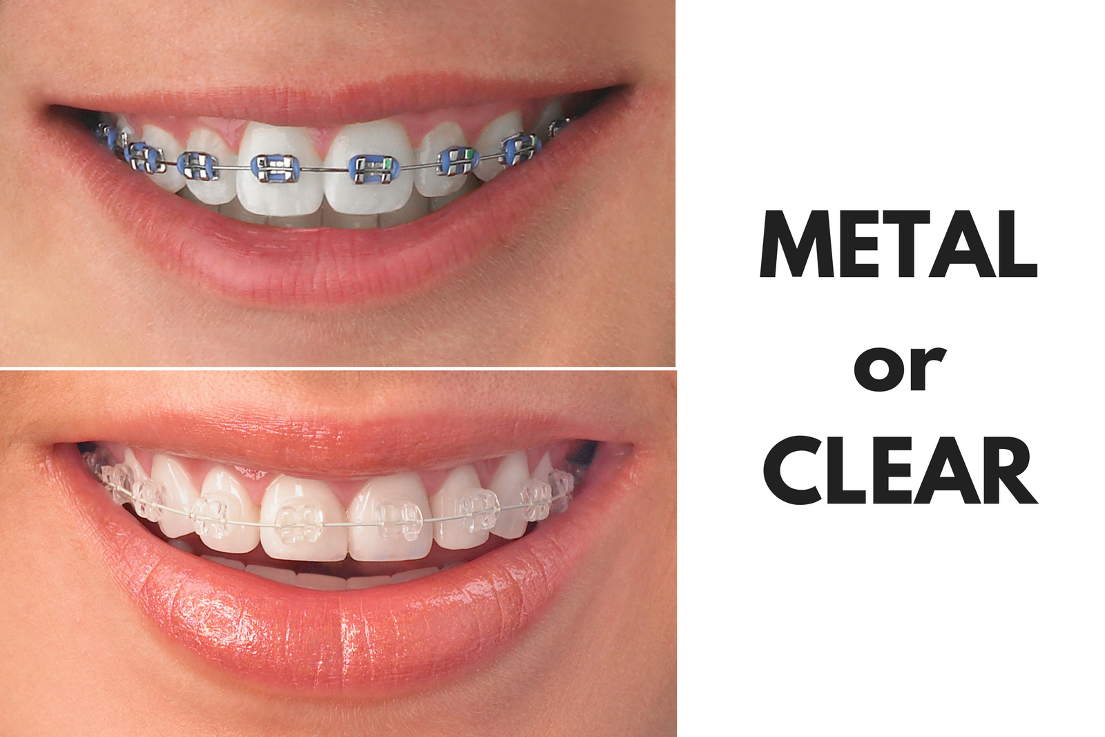 Ask Your Blanco Dentist: Should I Get Metal or Clear Braces?