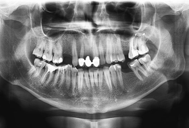 Panoramic dental X-ray showing full mouth teeth structure and bone density assessment.