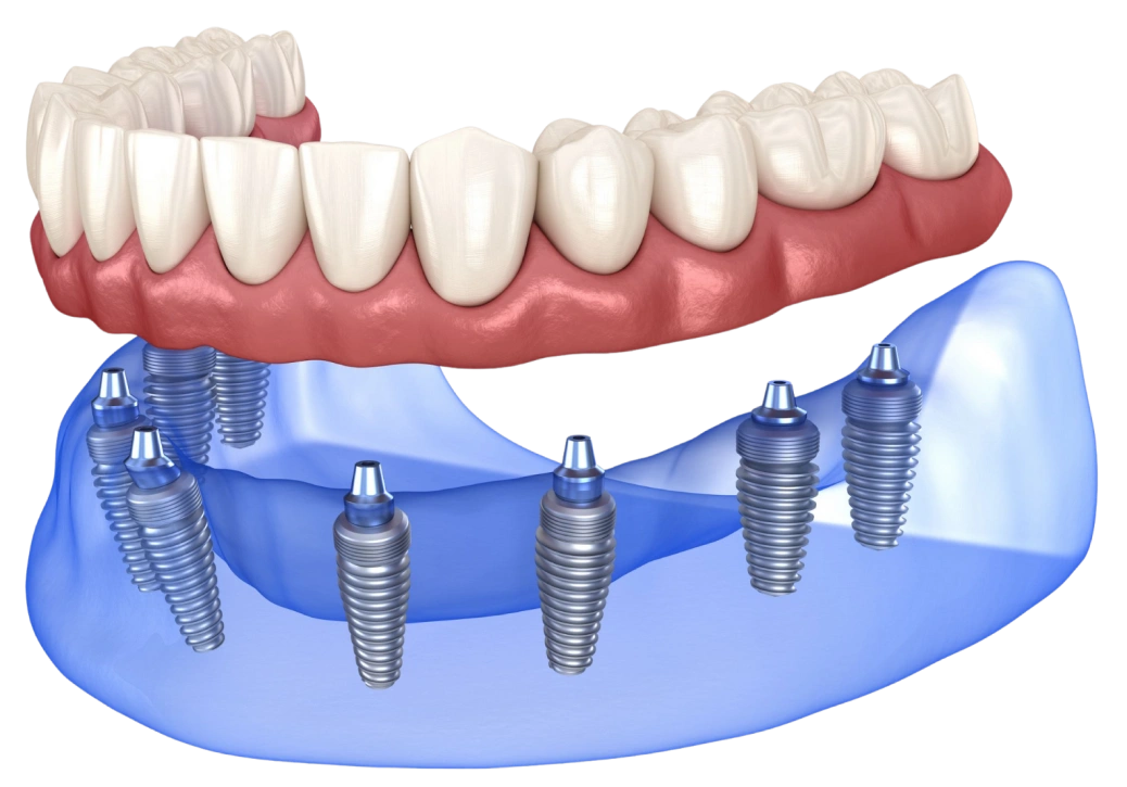 Dental implant prosthetic model showing tooth restoration with multiple implants and artificial teeth.