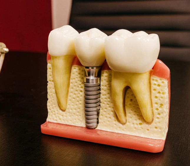 Dental implant model showing tooth structure, crown, and implant components on educational display.